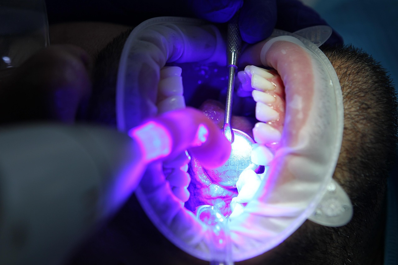 Blanqueamiento dental casero: método natural de 5 minutos para reducir el color amarillento